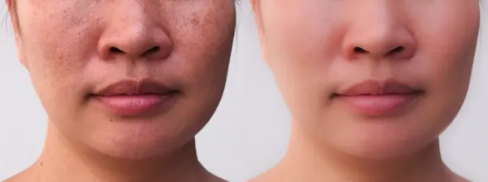 White Spots On Skin Reasons, Types, And Fixes